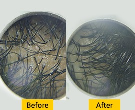 Hair  treatment at Jawed Habib Vijayawada